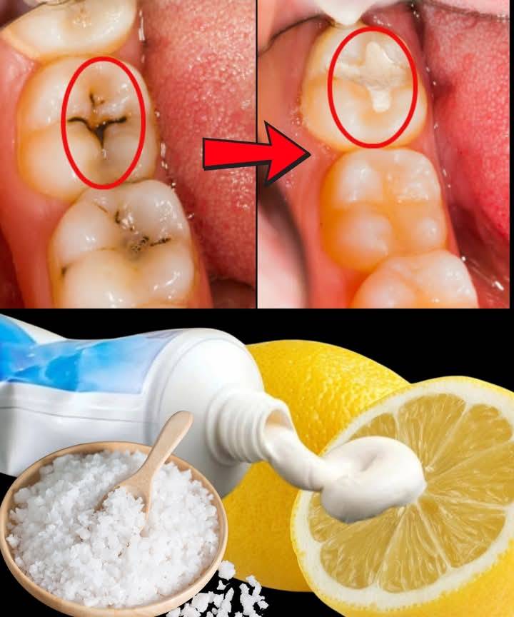 How to Naturally Repair a Cavity and Strengthen Your Teeth