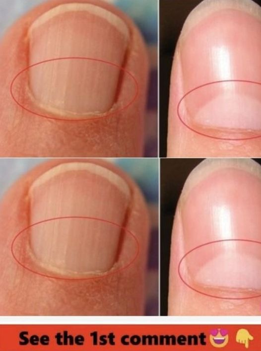 If You Don’t Have A Half Moon Shape On Your Nails, Visit A DOCTOR Immediately