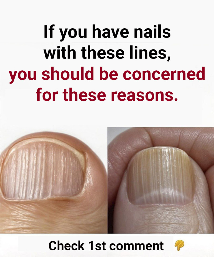 Understanding Why You Have Lines on Your Nails