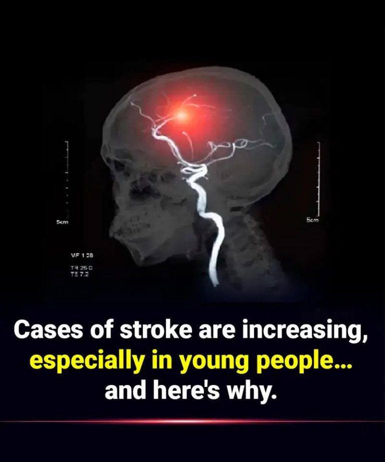 Cases of stroke are increasing, especially in young people… and here’s why.
