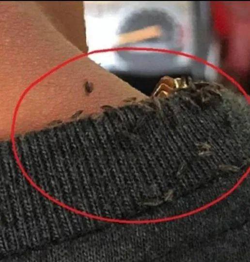 Man goes viral for extreme head lice infestation