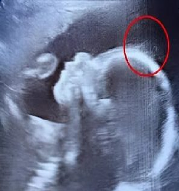 Doctors couldn’t believe what they saw during the ultrasoundv